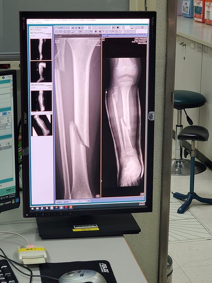 館長兒子的小腿骨直接斷成兩截，網友一看到照片直呼心疼。（翻攝自飆捍臉書）