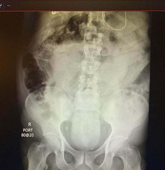 男病患的直腸X光片。（翻攝自VK）