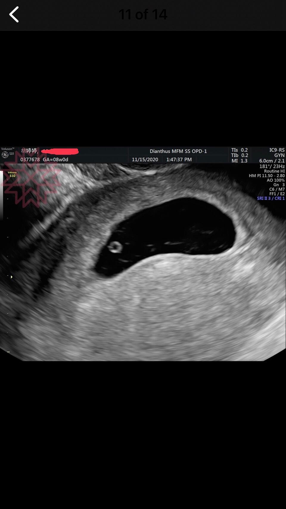 婷婷懷孕初期時的超音波照片。（鐵牛提供）