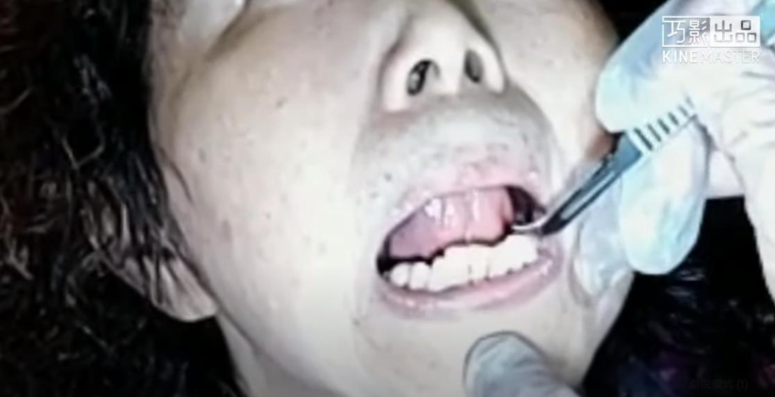 學員們將舌頭往上頂後，醫師拿刀在舌下靜脈處劃開兩道傷口，導致不少人當場流出滿口鮮血。（翻攝自YouTube）