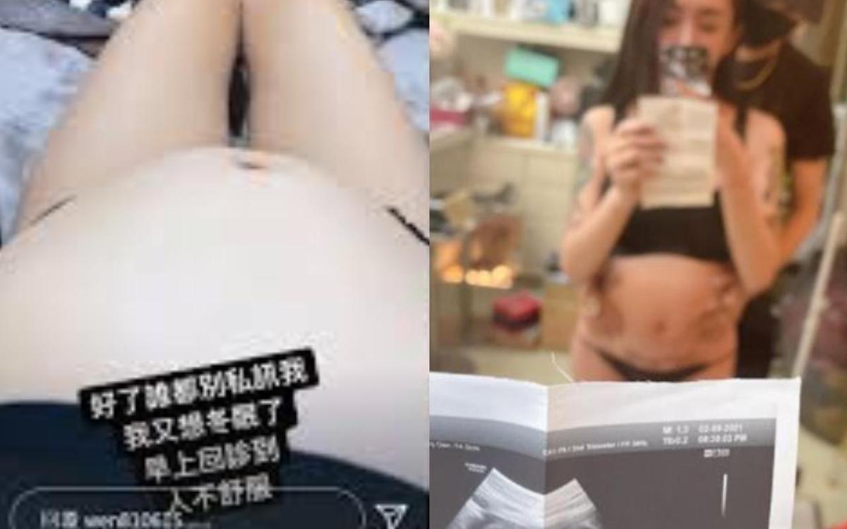 跨性別網紅「罔腰」公布懷孕12週的大肚子的照片，並附上高醫的超音波照以此證明，卻被高醫否認。（翻攝自罔腰IG）