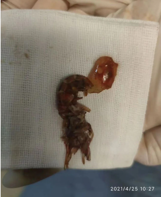 小龍蝦被取出後段成兩截死亡，被放在紗布上。（翻攝自微博）