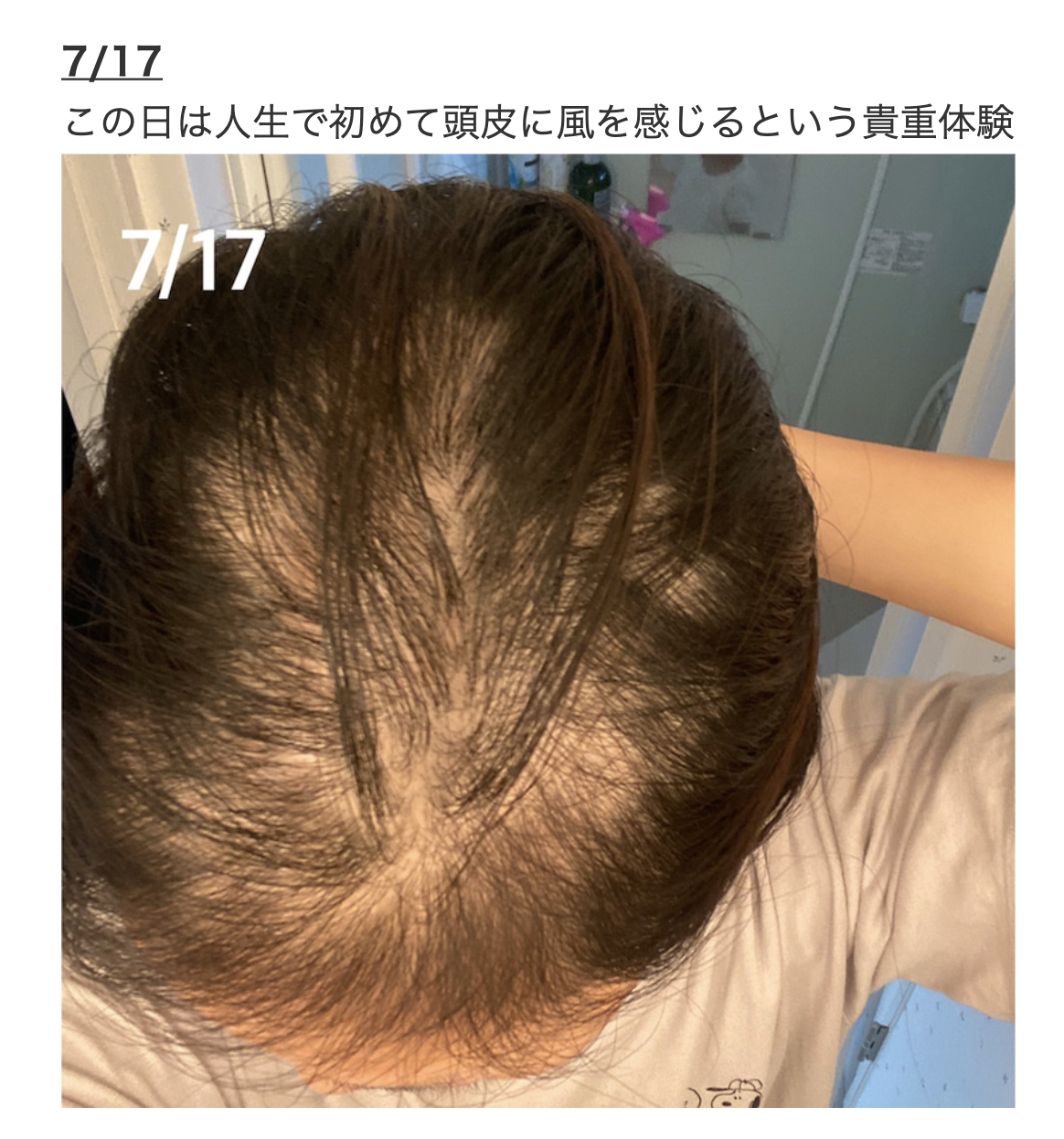 7月17日，頭髮已掉了一大半。（翻攝ameblo.jp網站）