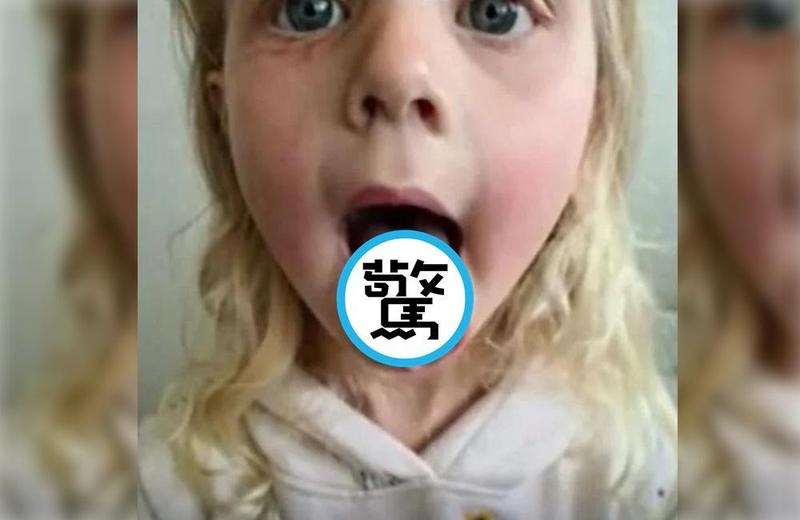 澳洲有名4歲女童一口氣吞了10顆酸糖，舌頭竟被燒出個大洞。（翻攝推特）