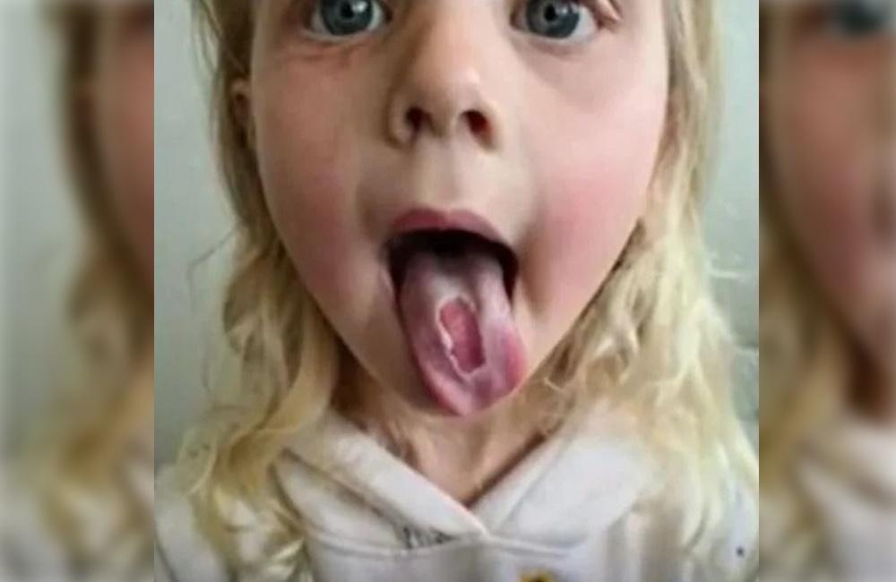 吃完糖果當下，女童感覺自己舌頭上的皮膚在脫落。（翻攝推特）