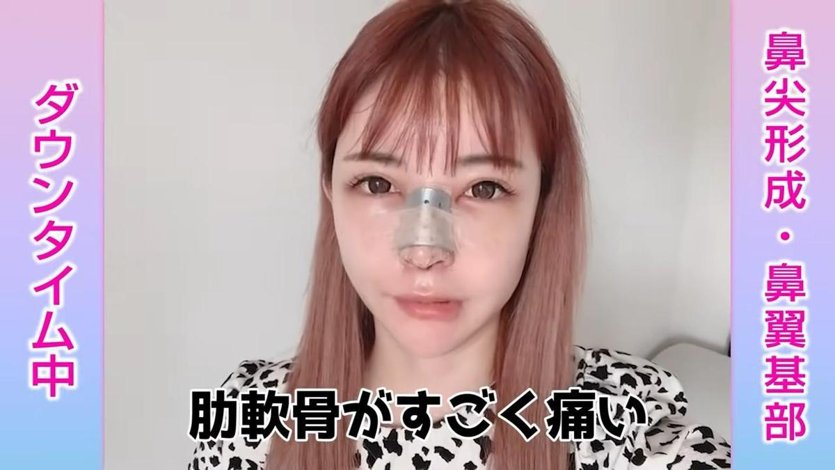 ▼知惠曾公開自己4次整鼻手術的過程。（圖／翻攝畫面／鏡週刊）