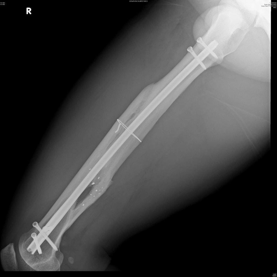 館長曾分享自己腿裡留有子彈碎片的X光照。（翻攝自飆捍臉書）