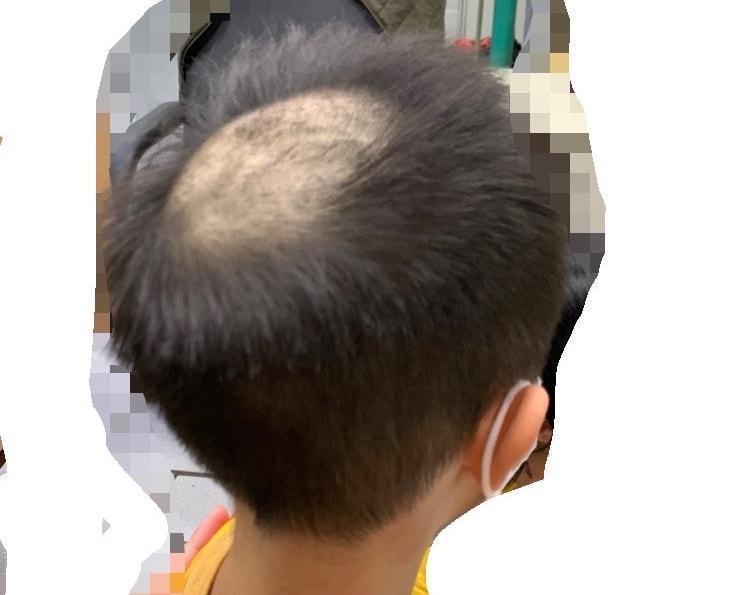 有網友Po出小孩驗髮變河童的慘況。（圖／翻攝臉書社團／鏡週刊提供）