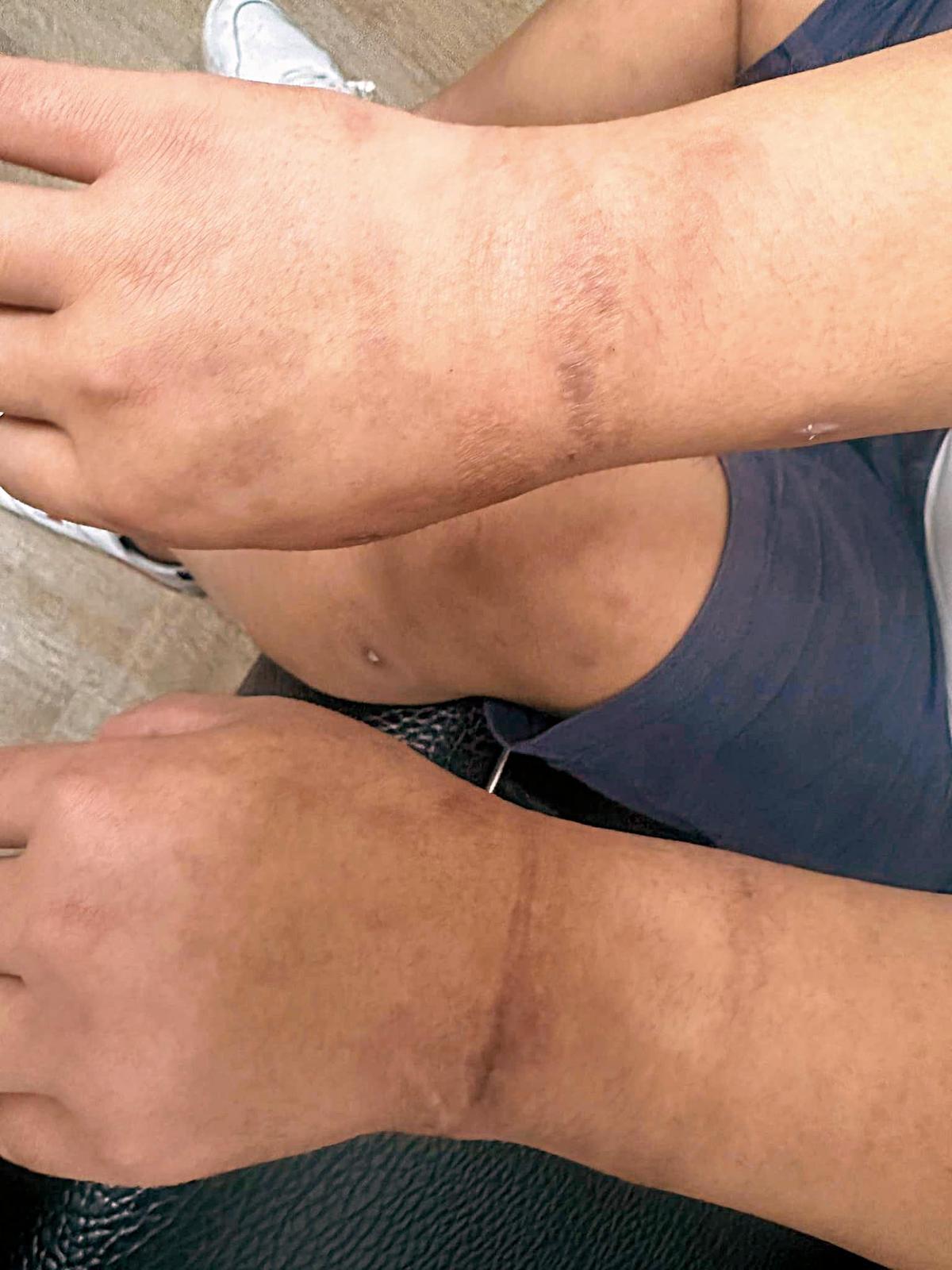 一名台中的早午餐業者被騙往柬埔寨，慘遭詐騙集團施暴，傷痕累累，雙手還有遭上銬的痕跡。（翻攝全球反詐騙組織臉書）