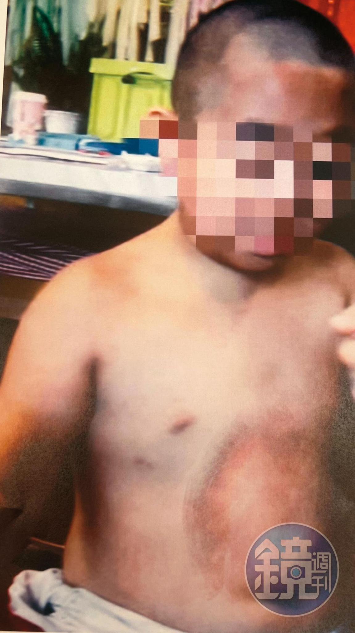 7歲男童小達（化名）遭快艇撞擊，頭、胸、腹部紅腫瘀傷。（讀者提供）
